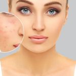 Curd For Pigmentation: ముఖంపై మంగు మచ్చలా ?  ఇది వాడితే..  ప్రాబ్లమ్ సాల్వ్