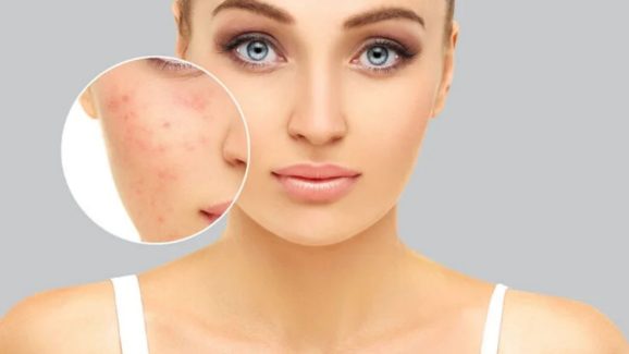 Curd For Pigmentation: ముఖంపై మంగు మచ్చలా ?  ఇది వాడితే..  ప్రాబ్లమ్ సాల్వ్