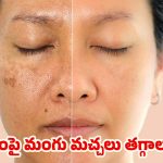 Aloe Vara For Pigmentation: ఈ ఒక్కటి వాడితే చాలు.. ముఖంపై మంగు మచ్చలు మాయం