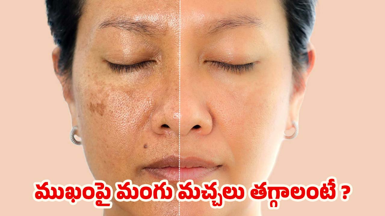 Aloe Vara For Pigmentation: ఈ ఒక్కటి వాడితే చాలు.. ముఖంపై మంగు మచ్చలు మాయం