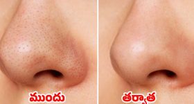 Blackheads On Nose: ముక్కుపై నల్ల మచ్చలా ? ఇవి వాడితే.. ప్రాబ్లమ్ సాల్వ్ !