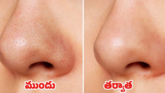 Blackheads On Nose: ముక్కుపై నల్ల మచ్చలా ? ఇవి వాడితే.. ప్రాబ్లమ్ సాల్వ్ !