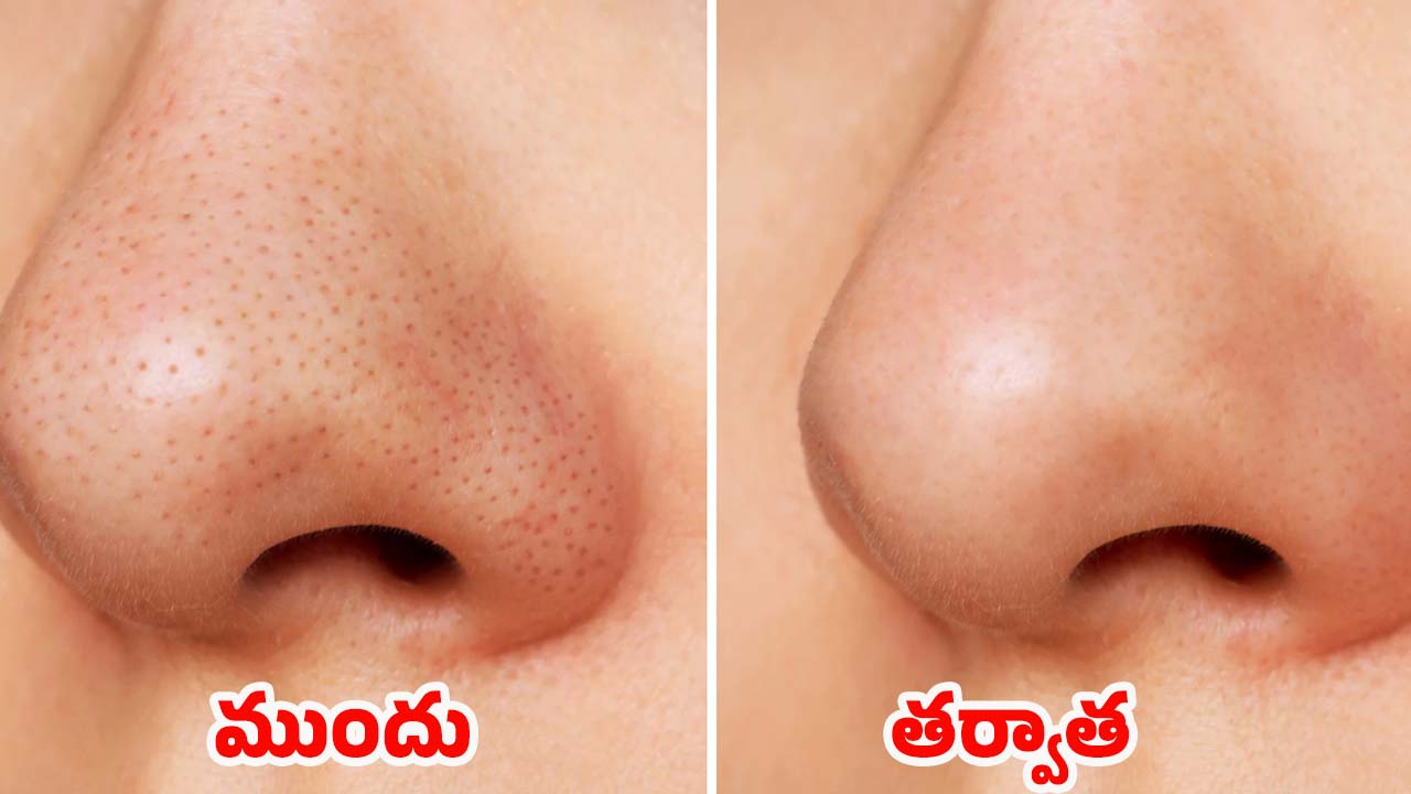 Blackheads On Nose: ముక్కుపై నల్ల మచ్చలా ? ఇవి వాడితే.. ప్రాబ్లమ్ సాల్వ్ !