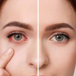Dry Eye Syndrome: డ్రై ఐ సిండ్రోమ్‌తో.. ఇబ్బంది పడుతున్నారా ?