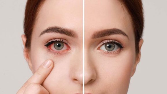 Dry Eye Syndrome: డ్రై ఐ సిండ్రోమ్‌తో.. ఇబ్బంది పడుతున్నారా ?
