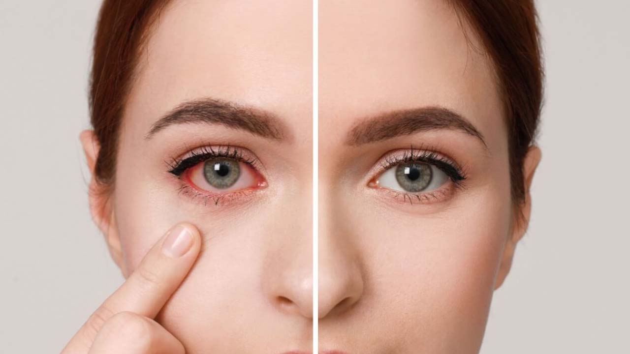 Dry Eye Syndrome: డ్రై ఐ సిండ్రోమ్‌తో.. ఇబ్బంది పడుతున్నారా ?