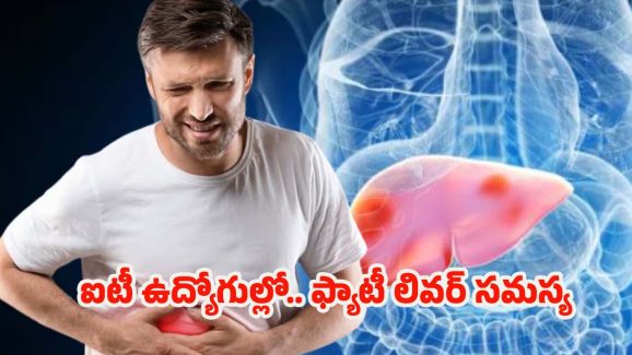 Fatty Liver: ఐటీ ఉద్యోగుల్లో ఫ్యాటీ లివర్ సమస్య.. పరిశోధనల్లో షాకింగ్ నిజాలు !