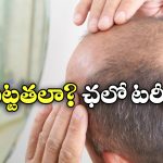 Hair Loss Treatment: టర్కీకి చెక్కేస్తున్న బట్టతల బాధితులు.. ఇంతకీ అక్కడి ప్రత్యేకత ఏమిటో తెలుసా?