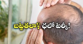 Hair Loss Treatment: టర్కీకి చెక్కేస్తున్న బట్టతల బాధితులు.. ఇంతకీ అక్కడి ప్రత్యేకత ఏమిటో తెలుసా?
