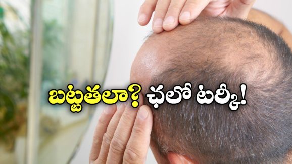 Hair Loss Treatment: టర్కీకి చెక్కేస్తున్న బట్టతల బాధితులు.. ఇంతకీ అక్కడి ప్రత్యేకత ఏమిటో తెలుసా?