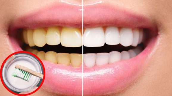 Teeth Cleaning Tips: పళ్లు తెల్లగా మెరిసిపోవాలంటే.. ఇప్పుడే ఇలా చేయండి !