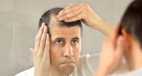 Seasonal Hair Fall: ఇలా చేస్తే.. ఎండాకాలంలో హెయిర్ ఫాల్‌కు చెక్ !