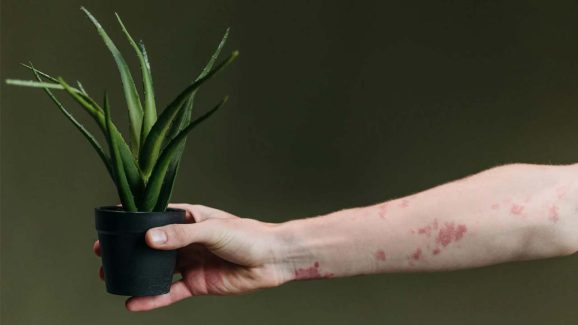 Cure Psoriasis: సోరియాసిస్‌ను సహజంగా తగ్గించుకోవడం సాధ్యమేనా? దీనికి శాశ్వతంగా చెక్ పెట్టడమెలా..?