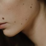 Moles: పుట్టు మచ్చలు ఎందుకు వస్తాయో తెలుసా?  వీటి వల్ల క్యాన్సర్ కూడా రావచ్చట..!