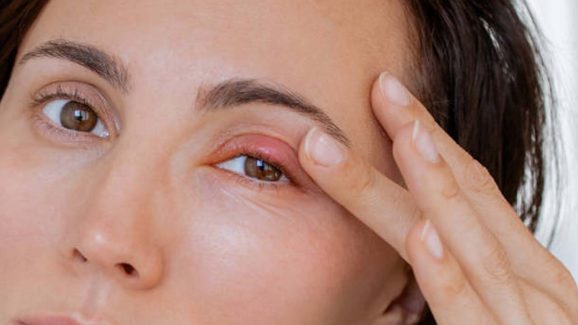 Stye: కంటి కురుపు ఎందుకు వస్తుంది? ఇంట్లోనే దీన్ని తగ్గించడం సాధ్యమేనా?