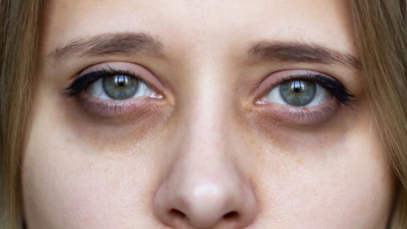 Dark circles: కళ్ల కింద డార్క్ సర్కిల్స్‌ని అలాగే వదిలేయకండి.. ఇలా చేస్తే కళ్లు అందంగా మారతాయి