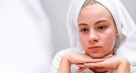 Pimples: ఏం చేసినా మొటిమలు తగ్గట్లేదా..? ఈ సింపుల్ టిప్స్ ట్రై చేసి చూడండి