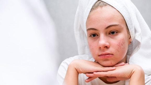 Pimples: ఏం చేసినా మొటిమలు తగ్గట్లేదా..? ఈ సింపుల్ టిప్స్ ట్రై చేసి చూడండి