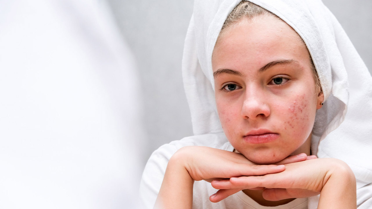 Pimples: ఏం చేసినా మొటిమలు తగ్గట్లేదా..? ఈ సింపుల్ టిప్స్ ట్రై చేసి చూడండి