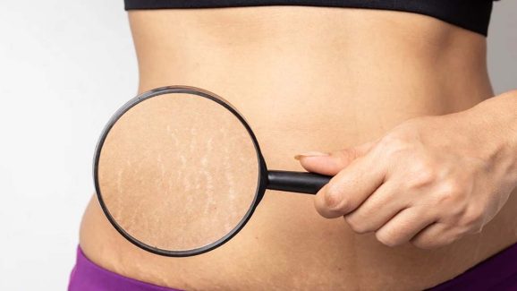 Stretch Marks: స్ట్రెచ్ మార్క్స్‌తో.. ఇబ్బంది పడుతున్నారా ? ఇలా చేస్తే.. ప్రాబ్లమ్ సాల్వ్