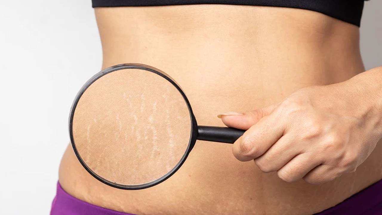 Stretch Marks: స్ట్రెచ్ మార్క్స్‌తో.. ఇబ్బంది పడుతున్నారా ? ఇలా చేస్తే.. ప్రాబ్లమ్ సాల్వ్