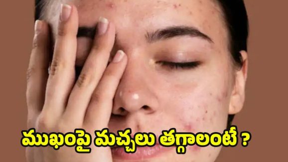 Black Spots: ముఖంపై మచ్చలు తగ్గి, తెల్లగా మెరిసిపోవాలంటే.. ఈ టిప్స్ ట్రై చేయండి
