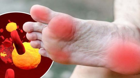 High Cholesterol: కొలెస్ట్రాల్ పెరిగితే.. పాదాల్లో కనిపించే లక్షణాలు ఇవే !