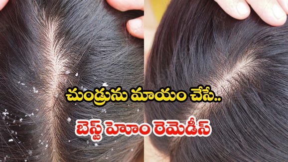 Hair Mask For Dandruff: వీటితో.. క్షణాల్లోనే చుండ్రు మాయం !