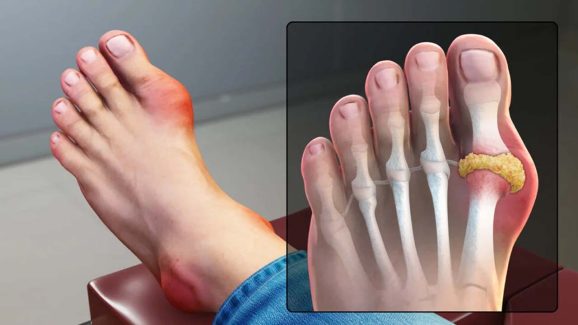 High Uric Acid: మీలో ఈ లక్షణాలున్నాయా ? జాగ్రత్త పడకపోతే ఇక అంతే..