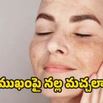 Dark Spots On Face: ముఖంపై నల్ల మచ్చలా ? ఇలా చేస్తే.. సమస్య దూరం