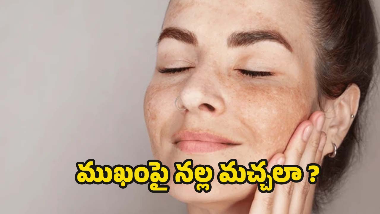 Dark Spots On Face: ముఖంపై నల్ల మచ్చలా ? ఇలా చేస్తే.. సమస్య దూరం
