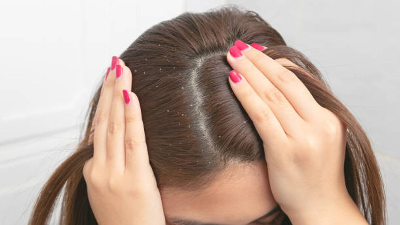 Dandruff: చుండ్రు ఎందుకు వస్తుంది? చిట్కాలతో దీన్ని తగ్గించుకోవచ్చా..?