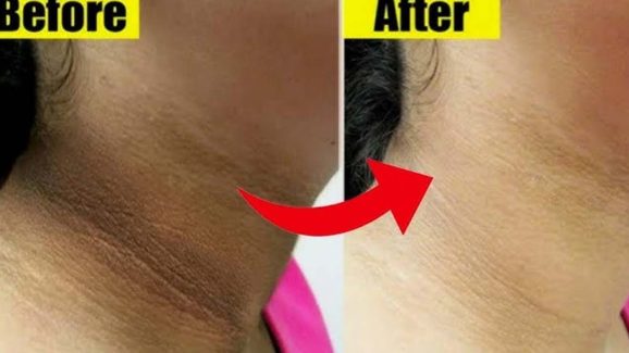 Neck Tanning: ఇలా చేస్తే.. మెడపై ఉన్న నలుపు క్షణాల్లోనే మాయం !