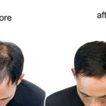 Hair Regrowth: ఊడిన చోట జుట్టు ఒత్తుగా పెరగాలంటే.. ?