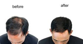 Hair Regrowth: ఊడిన చోట జుట్టు ఒత్తుగా పెరగాలంటే.. ?