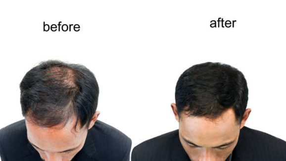 Hair Regrowth: ఊడిన చోట జుట్టు ఒత్తుగా పెరగాలంటే.. ?