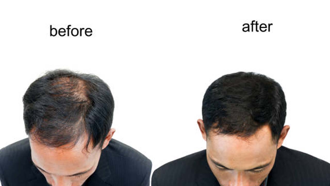 Hair Regrowth: ఊడిన చోట జుట్టు ఒత్తుగా పెరగాలంటే.. ?