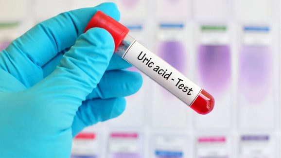 Ayurveda for Uric Acid: ఆయుర్వేద చిట్కాలతో యూరిక్ యాసిడ్ లెవెల్స్ తగ్గుతాయా..? వైద్యులు ఏం చెప్తున్నారంటే