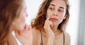 Pimples: మొటిమలు ఎందుకు వస్తాయి? వీటిని తగ్గించుకోవాలంటే ఏం చేయాలి?