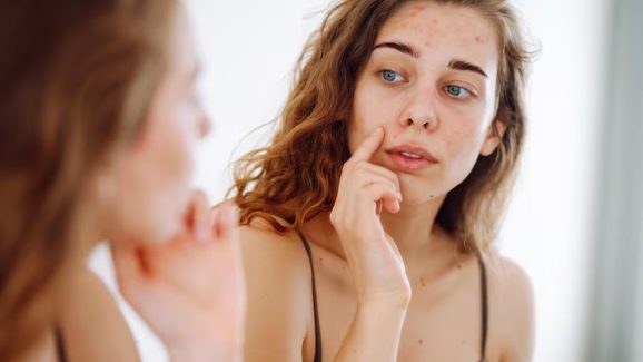 Pimples: మొటిమలు ఎందుకు వస్తాయి? వీటిని తగ్గించుకోవాలంటే ఏం చేయాలి?