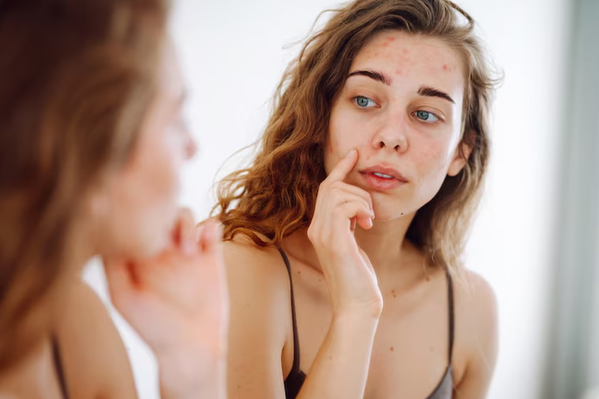 Pimples: మొటిమలు ఎందుకు వస్తాయి? వీటిని తగ్గించుకోవాలంటే ఏం చేయాలి?
