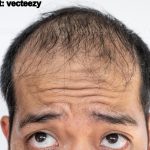 Hair Loss Natural Solution: మీ జుట్టు రాలిపోయిందా?.. చింతించకండి.. బలమైన జుట్టు తిరిగిరావాలంటే ఇలా చేయండి