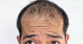 Hair Loss Natural Solution: మీ జుట్టు రాలిపోయిందా?.. చింతించకండి.. బలమైన జుట్టు తిరిగిరావాలంటే ఇలా చేయండి