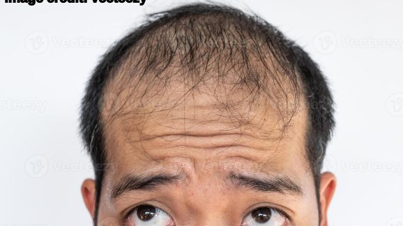 Hair Loss Natural Solution: మీ జుట్టు రాలిపోయిందా?.. చింతించకండి.. బలమైన జుట్టు తిరిగిరావాలంటే ఇలా చేయండి