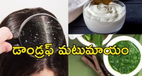 Dandruff Ayurvedic Mask: చుండ్రుతో బాధపడుతున్నారా?.. ఆయుర్వేదిక్ హెయిర్ మాస్క్‌తో సమస్యకు పరిష్కారం