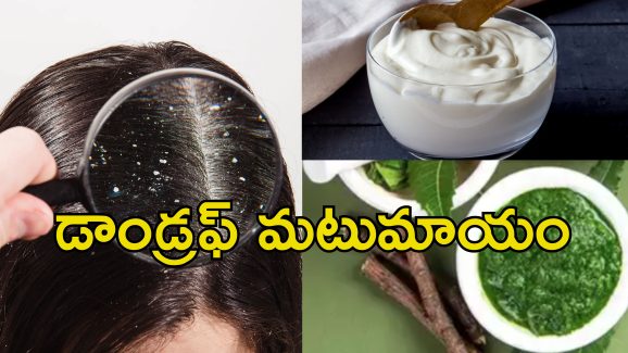 Dandruff Ayurvedic Mask: చుండ్రుతో బాధపడుతున్నారా?.. ఆయుర్వేదిక్ హెయిర్ మాస్క్‌తో సమస్యకు పరిష్కారం