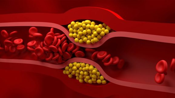 Bad cholesterl : చెడు కొలెస్ట్రాల్ చింత ఎందుకు.. వీటిని తింటే అంతా సెట్..