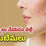 Pimples Skincare Tips: వేసవిలో మొటిమల సమస్య.. క్లీన్ చర్మం కోసం ఈ చిట్కాలు పాటించండి