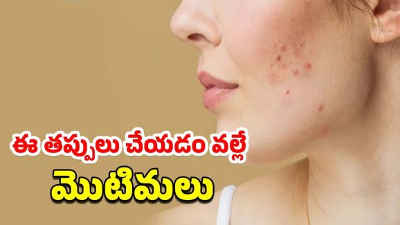 Pimples Skincare Tips: వేసవిలో మొటిమల సమస్య.. క్లీన్ చర్మం కోసం ఈ చిట్కాలు పాటించండి