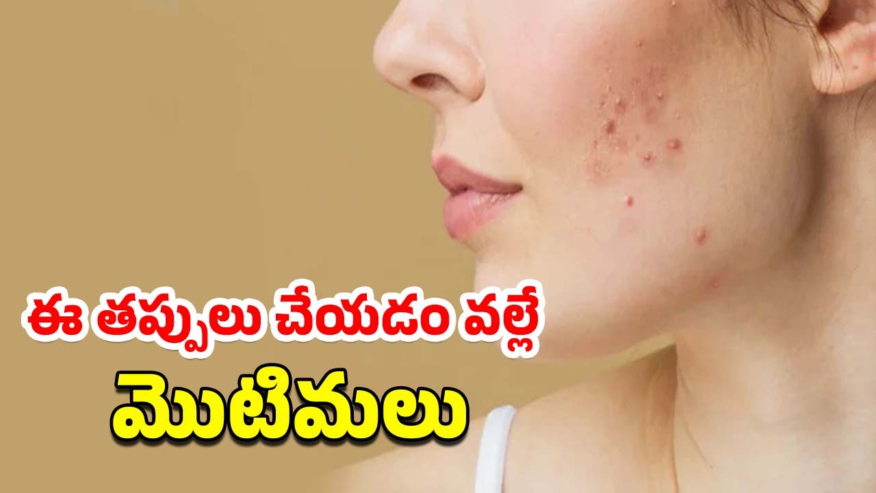 Pimples Skincare Tips: వేసవిలో మొటిమల సమస్య.. క్లీన్ చర్మం కోసం ఈ చిట్కాలు పాటించండి